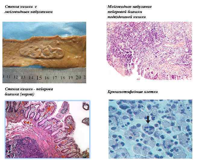 Стенка кишки с мозговидным набуханием Стенка кишки - пейерова бляшка (норма) Мозговидное набухание пейеровой