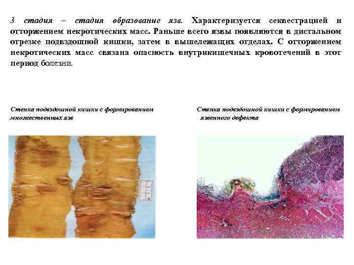 3 стадия – стадия образование язв. Характеризуется секвестрацией и отторжением некротических масс. Раньше всего