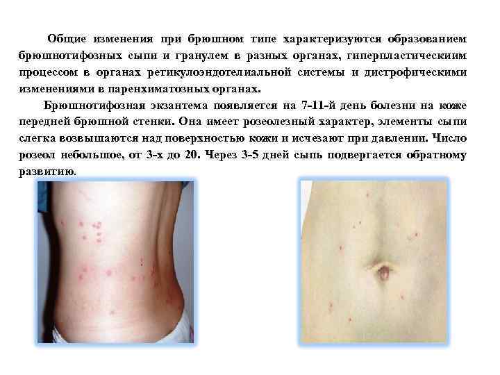  Общие изменения при брюшном типе характеризуются образованием брюшнотифозных сыпи и гранулем в разных