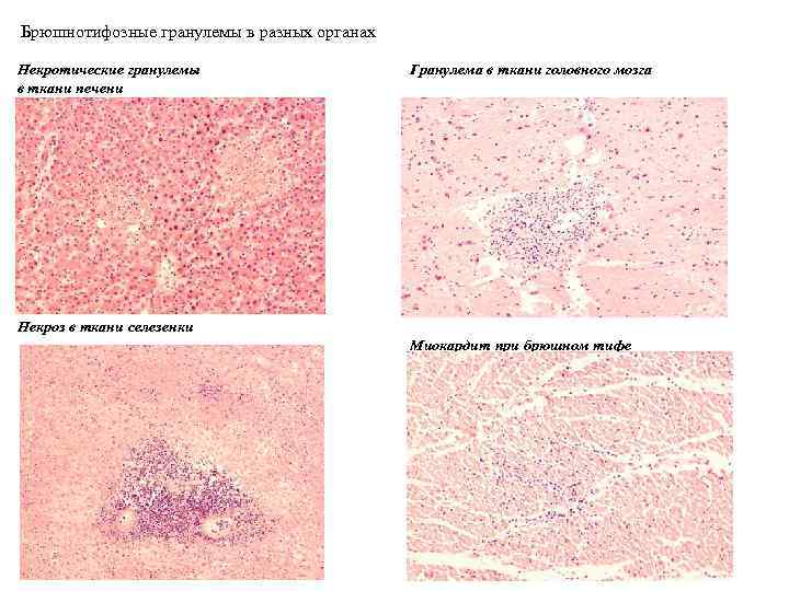 Брюшнотифозные гранулемы в разных органах Некротические гранулемы в ткани печени Гранулема в ткани головного