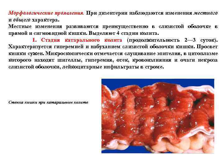 Морфологические проявления. При дизентерии наблюдаются изменения местного и общего характера. Местные изменения развиваются преимущественно