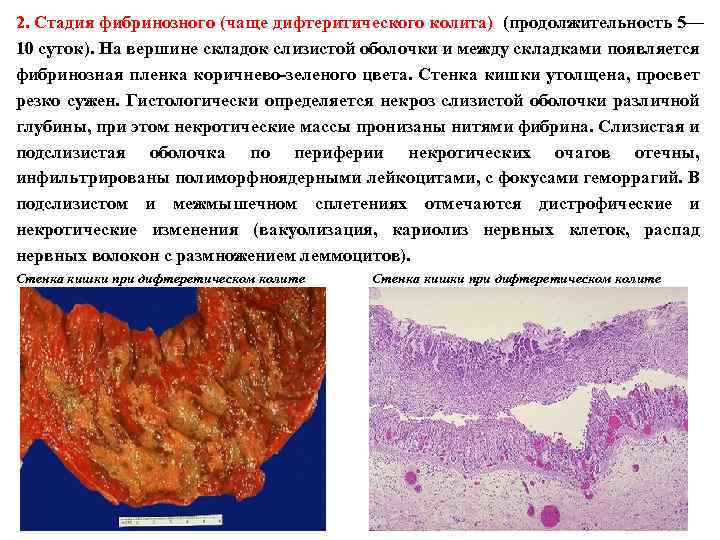 2. Стадия фибринозного (чаще дифтеритического колита) (продолжительность 5— 10 суток). На вершине складок слизистой
