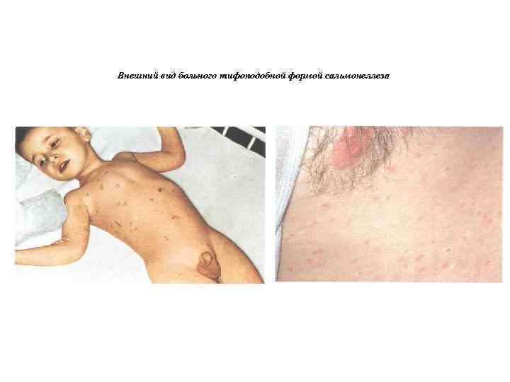 Внешний вид больного тифоподобной формой сальмонеллеза 
