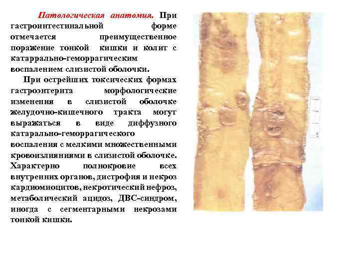  Патологическая анатомия. При гастроинтестинальной форме отмечается преимущественное поражение тонкой кишки и колит с