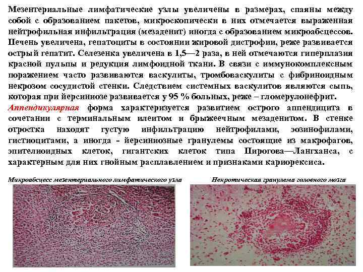 Мезентериальные лимфатические узлы увеличены в размерах, спаяны между собой с образованием пакетов, микроскопически в