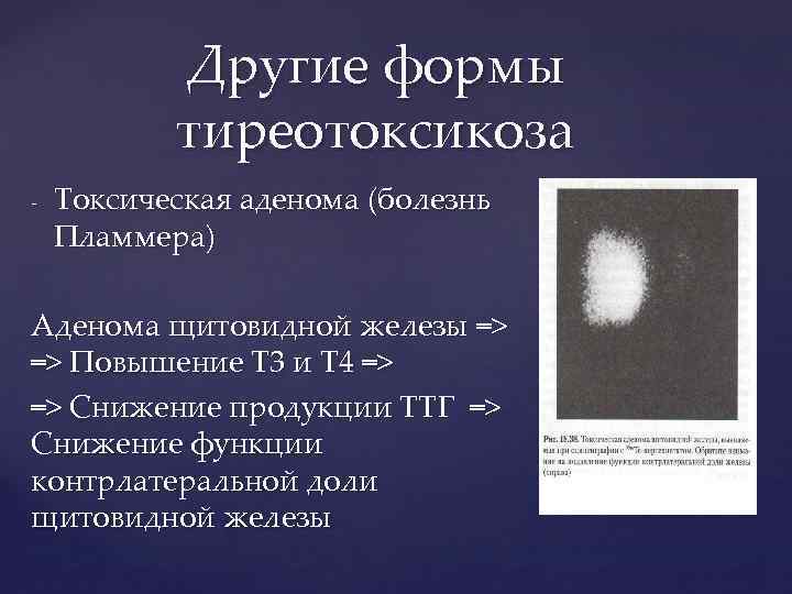 Другие формы тиреотоксикоза - Токсическая аденома (болезнь Пламмера) Аденома щитовидной железы => => Повышение