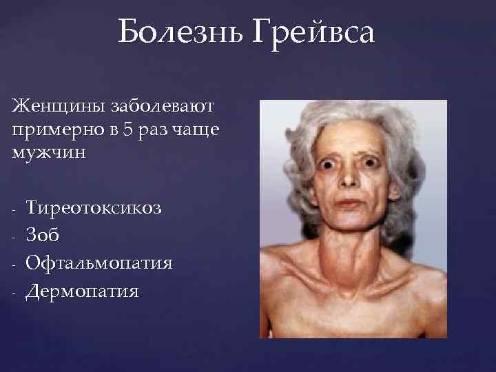 Болезнь Грейвса Женщины заболевают примерно в 5 раз чаще мужчин - Тиреотоксикоз Зоб Офтальмопатия