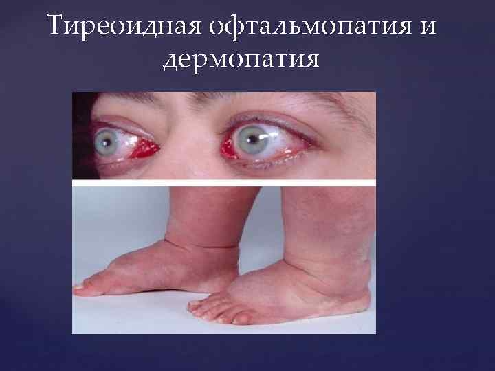 Тиреоидная офтальмопатия и дермопатия 