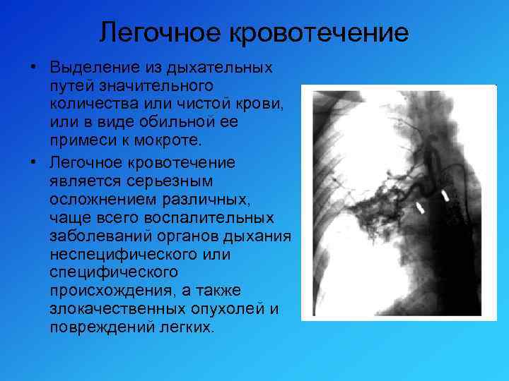 Легочное кровотечение • Выделение из дыхательных путей значительного количества или чистой крови, или в