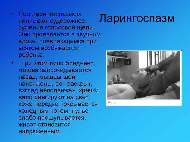  • Под ларингоспазмом понимают судорожное сужение голосовой щели. Оно проявляется в звучном вдохе,