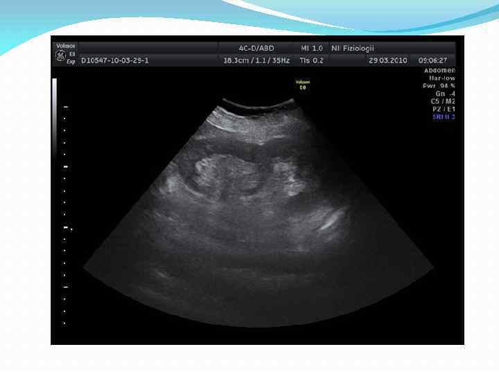 Уз картина. Неполное удвоение почки на УЗИ. Удвоение почки УЗИ протокол. Удвоение почки УЗИ признаки. Полное удвоение почки на УЗИ.