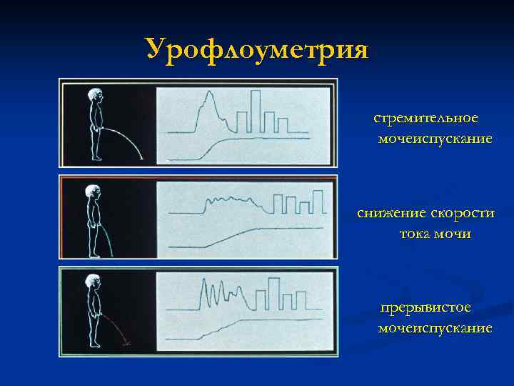 Мочеиспускание без струи. Прерывистое мочеиспускание. Прерывистый Тип мочеиспускания. Гиперактивный мочевой пузырь урофлоуметрия. Прерывистая струя мочи у мужчин.