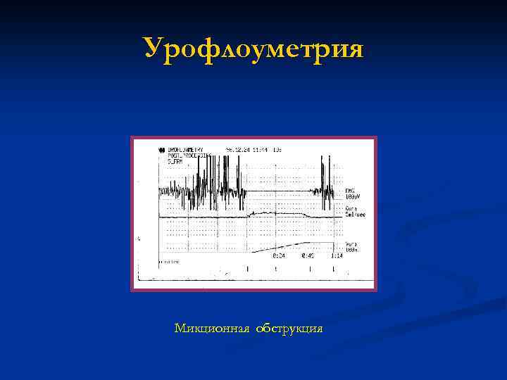 Урофлоуметрия Микционная обструкция 