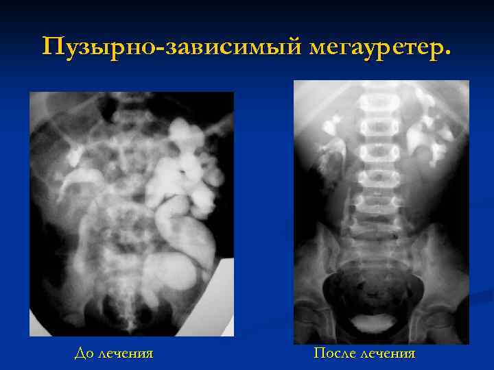 Пузырно-зависимый мегауретер. До лечения После лечения 