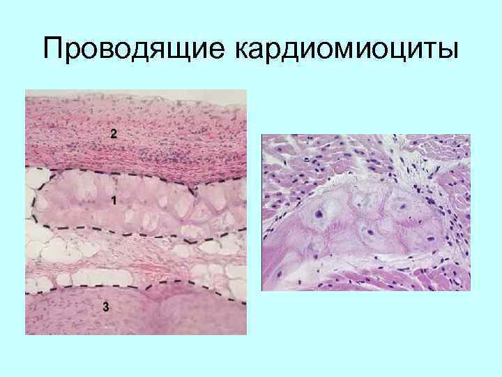 Атипичные кардиомиоциты рисунок