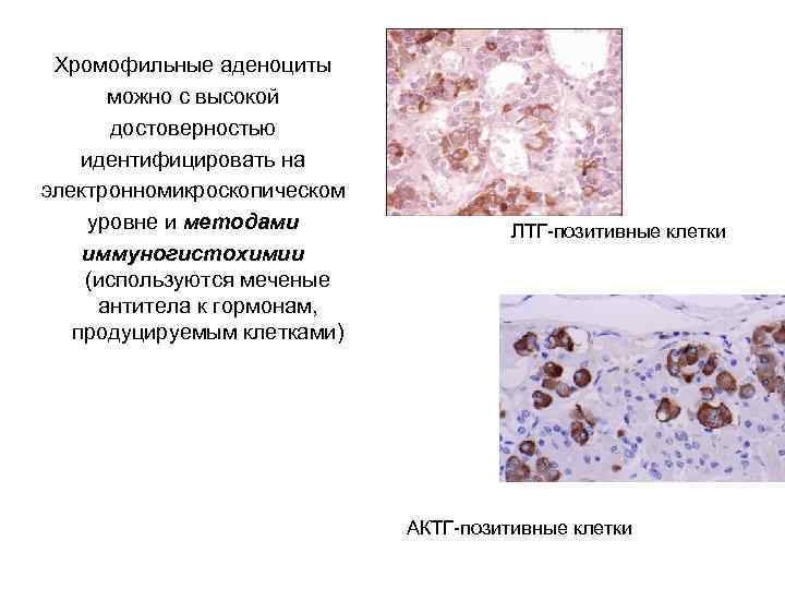 Хромофильные аденоциты можно с высокой достоверностью идентифицировать на электронномикроскопическом уровне и методами иммуногистохимии (используются