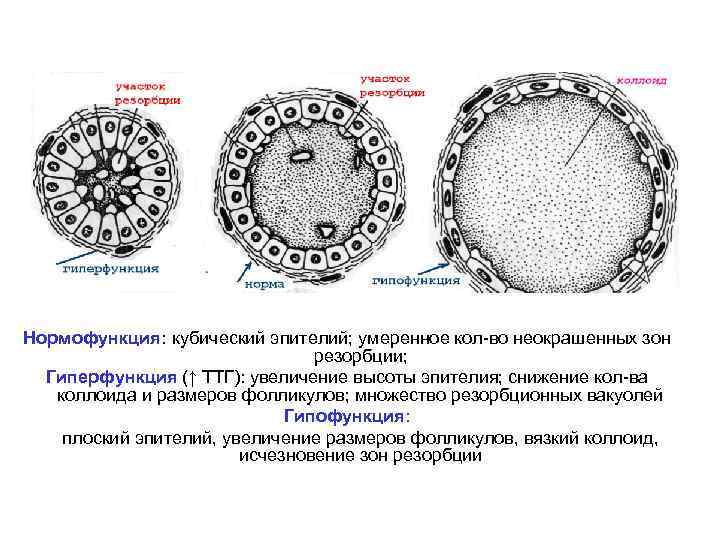 Нормофункция: кубический эпителий; умеренное кол-во неокрашенных зон резорбции; Гиперфункция (↑ ТТГ): увеличение высоты эпителия;