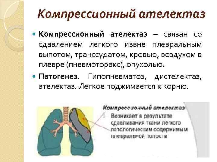 Компрессионный ателектаз – связан со сдавлением легкого извне плевральным выпотом, транссудатом, кровью, воздухом в