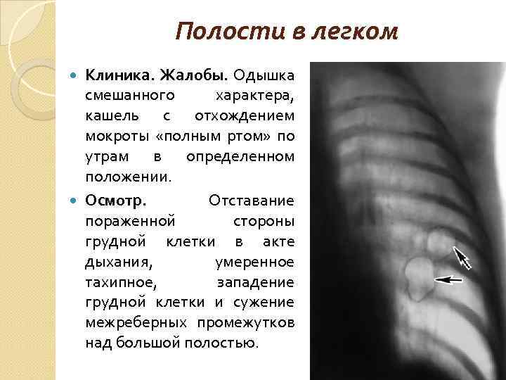 Полости в легком Клиника. Жалобы. Одышка смешанного характера, кашель с отхождением мокроты «полным ртом»