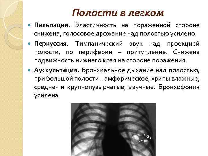 Полости в легком Пальпация. Эластичность на пораженной стороне снижена, голосовое дрожание над полостью усилено.