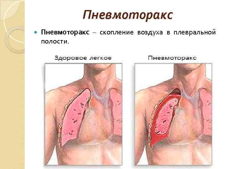 Пневмоторакс – скопление воздуха в плевральной полости. 