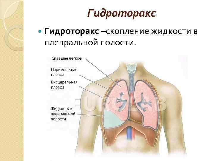 Гидроторакс –скопление жидкости в плевральной полости. 