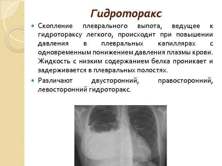 Гидроторакс Скопление плеврального выпота, ведущее к гидротораксу легкого, происходит при повышении давления в плевральных