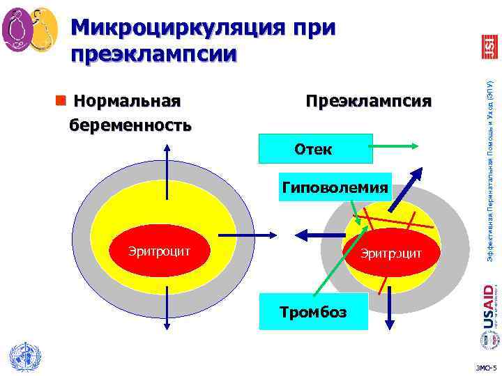 n Нормальная беременность Преэклампсия Отек Гиповолемия Эритроцит Эффективная Перинатальная Помощь и Уход (ЭПУ) Микроциркуляция