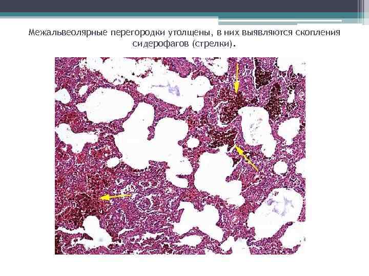 Межальвеолярные перегородки утолщены, в них выявляются скопления сидерофагов (стрелки). 