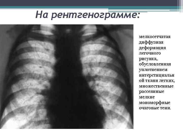 На рентгенограмме: мелкосетчатая диффузная деформация легочного рисунка, обусловленная уплотнением интерстициальн ой ткани легких, множественные