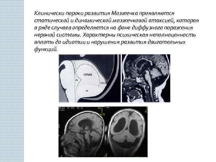 Клинически пороки развития Мозжечка проявляются статической и динамической мозжечковой атаксией, которая в ряде случаев