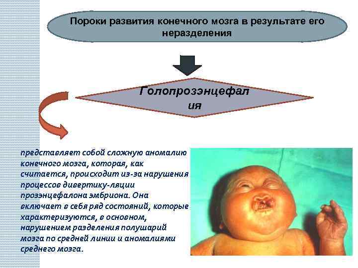 Пороки развития конечного мозга в результате его неразделения Голопрозэнцефал ия представляет собой сложную аномалию