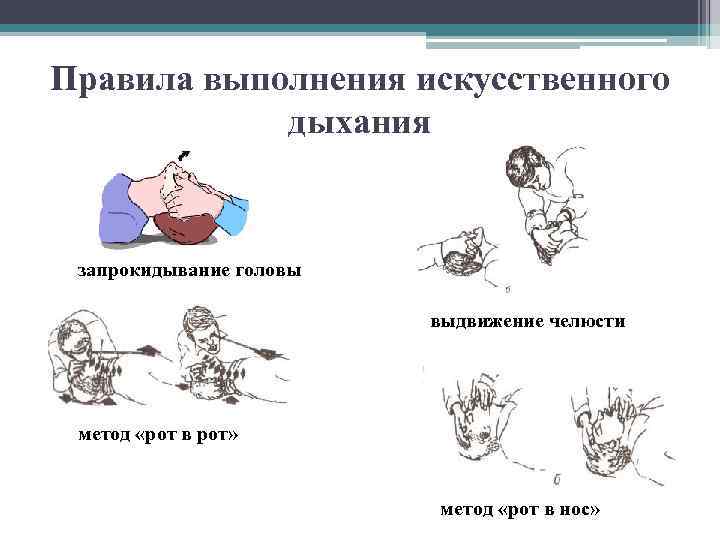 Правила выполнения искусственного дыхания запрокидывание головы выдвижение челюсти метод «рот в рот» метод «рот