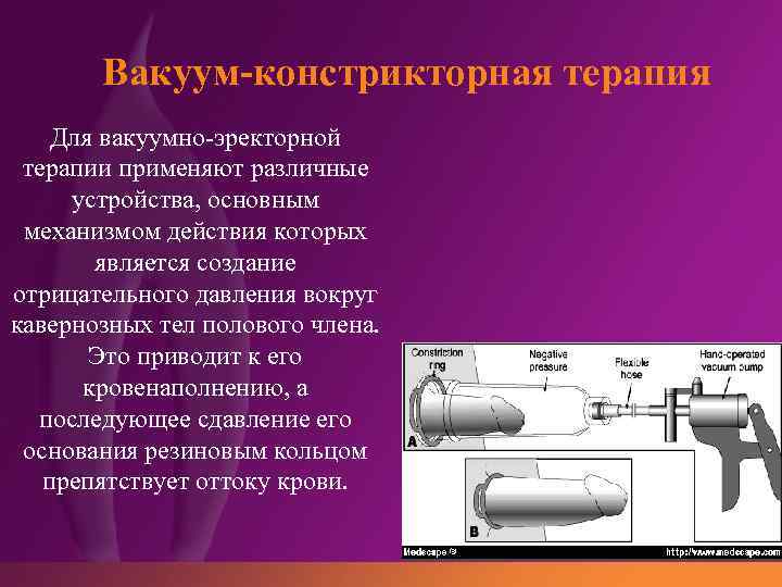 Вакуум-констрикторная терапия Для вакуумно-эректорной терапии применяют различные устройства, основным механизмом действия которых является создание
