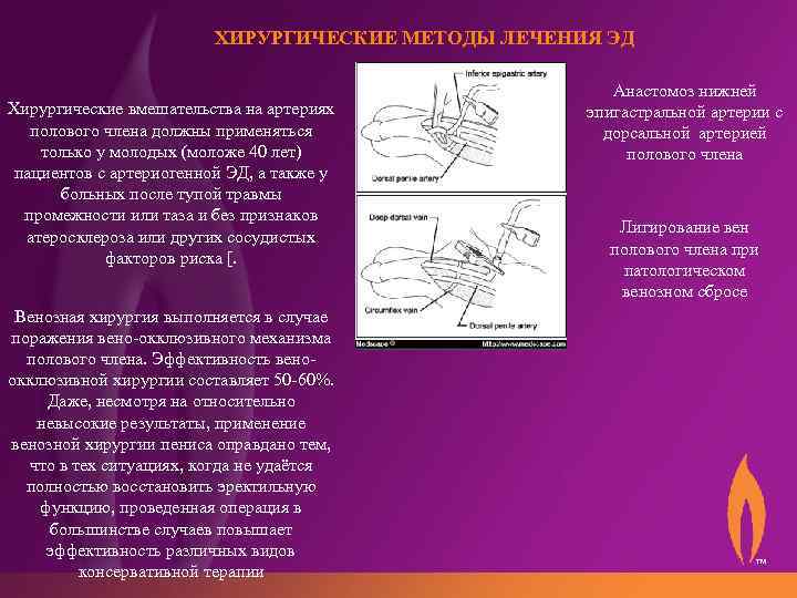 ХИРУРГИЧЕСКИЕ МЕТОДЫ ЛЕЧЕНИЯ ЭД Хирургические вмешательства на артериях полового члена должны применяться только у