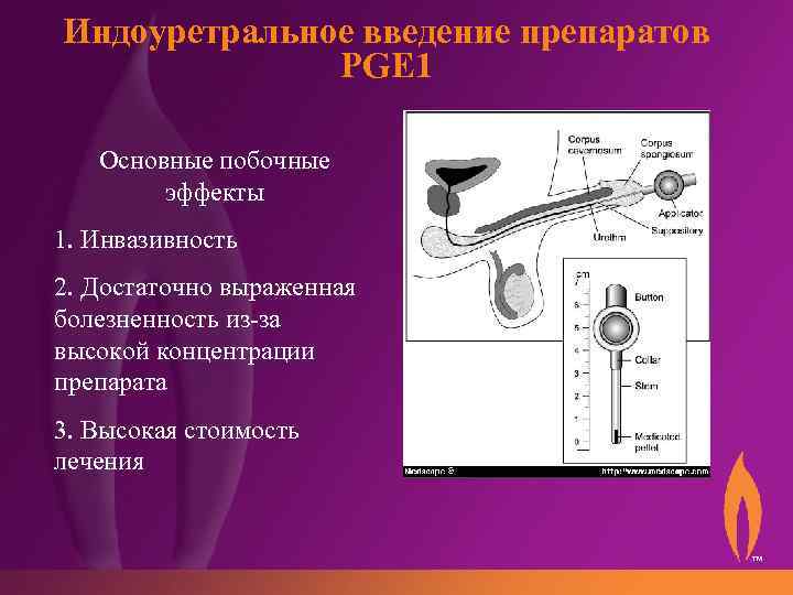Индоуретральное введение препаратов PGE 1 Основные побочные эффекты 1. Инвазивность 2. Достаточно выраженная болезненность