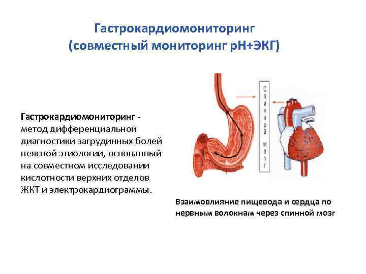 Гастрокардиомониторинг (совместный мониторинг р. Н+ЭКГ) Гастрокардиомониторинг метод дифференциальной диагностики загрудинных болей неясной этиологии, основанный