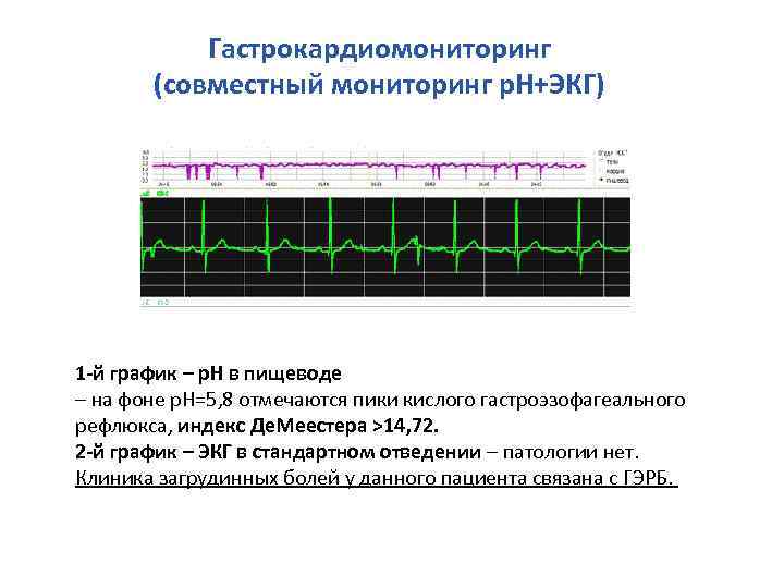 Гастрокардиомониторинг (совместный мониторинг р. Н+ЭКГ) 1 -й график – р. Н в пищеводе –