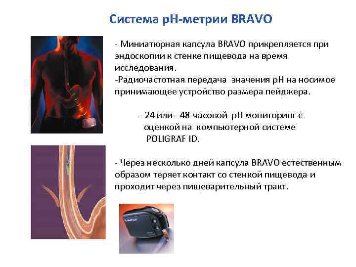 Система р. Н-метрии BRAVO Миниатюрная капсула BRAVO прикрепляется при эндоскопии к стенке пищевода на