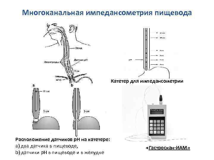 Многоканальная импедансометрия пищевода Катетер для импедансометрии Расположение датчиков р. Н на катетере: а) два