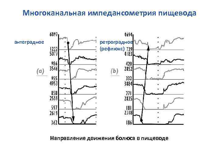 Многоканальная импедансометрия пищевода антеградное ретроградное (рефлюкс) Направление движения болюса в пищеводе 