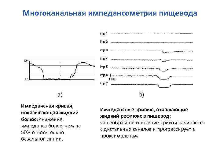 Многоканальная импедансометрия пищевода Импедансная кривая, показывающая жидкий болюс: снижение импеданса более, чем на 50%