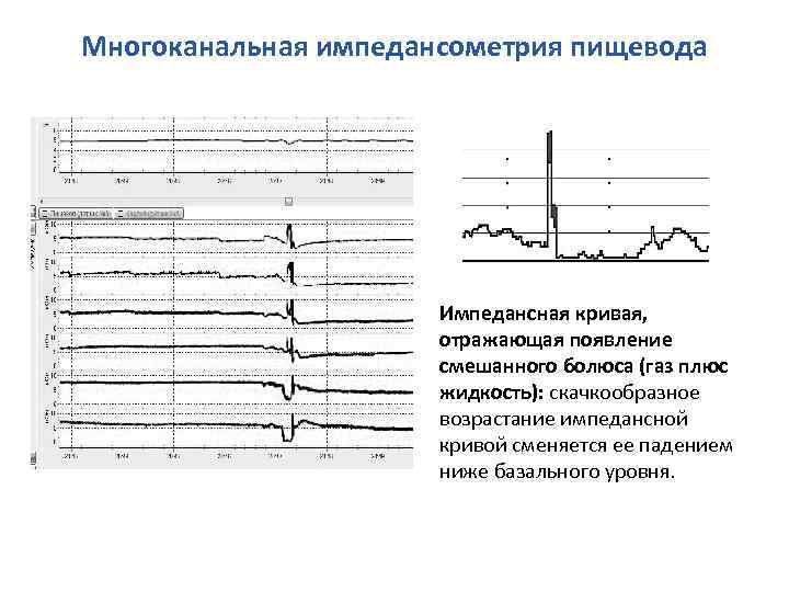 Многоканальная импедансометрия пищевода Импедансная кривая, отражающая появление смешанного болюса (газ плюс жидкость): скачкообразное возрастание