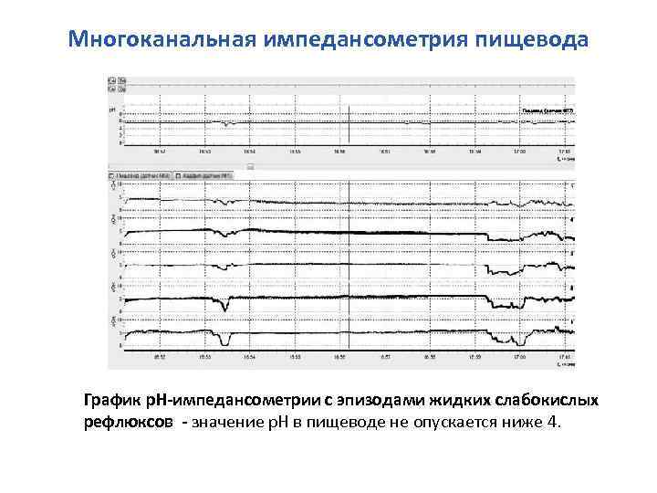 Многоканальная импедансометрия пищевода График р. Н-импедансометрии с эпизодами жидких слабокислых рефлюксов - значение р.