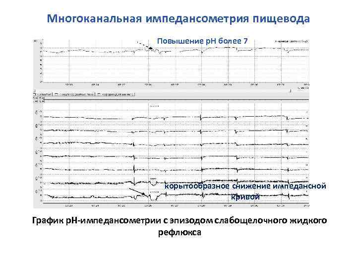 Многоканальная импедансометрия пищевода Повышение р. Н более 7 корытообразное снижение импедансной кривой График р.