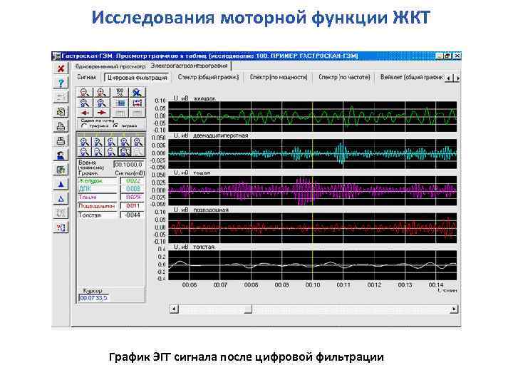 Исследования моторной функции ЖКТ График ЭГГ сигнала после цифровой фильтрации 