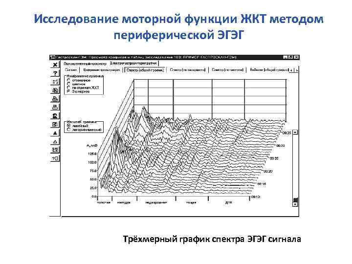 Исследование моторной функции ЖКТ методом периферической ЭГЭГ Трёхмерный график спектра ЭГЭГ сигнала 