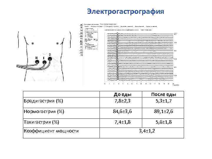 Электрогастрография Брадигастрия (%) До еды 7, 8± 2, 3 После еды 5, 3± 1,