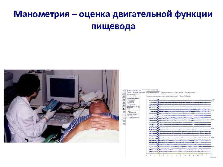 Манометрия – оценка двигательной функции пищевода 