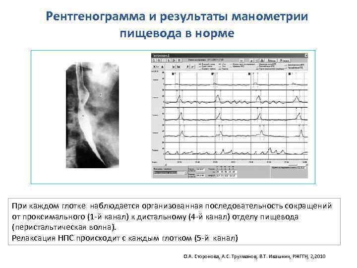 Рентгенограмма и результаты манометрии пищевода в норме При каждом глотке наблюдается организованная последовательность сокращений